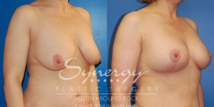 Before & After Breast Lift (Mastopexy) Case 39 View #3 View in Austin, TX