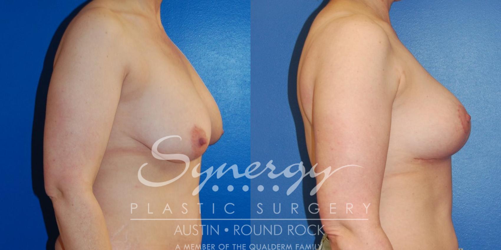Before & After Breast Lift (Mastopexy) Case 39 View #4 View in Round Rock, TX