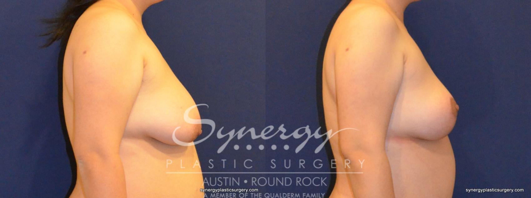 Before & After Breast Lift (Mastopexy) Case 396 View #2 View in Austin, TX