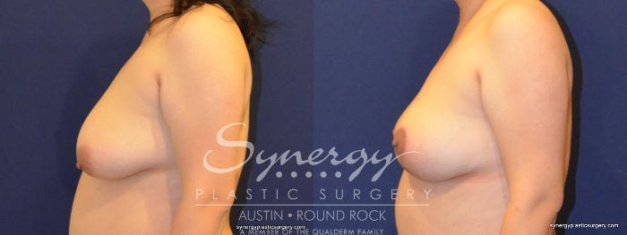 Before & After Breast Lift (Mastopexy) Case 396 View #4 View in Austin, TX