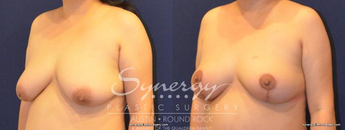Before & After Breast Lift (Mastopexy) Case 396 View #5 View in Austin, TX