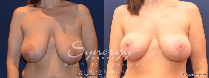 Before & After Breast Lift (Mastopexy) Case 407 View #1 View in Austin, TX