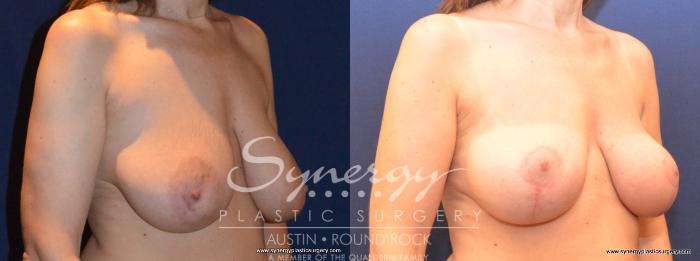 Before & After Breast Lift (Mastopexy) Case 407 View #2 View in Austin, TX