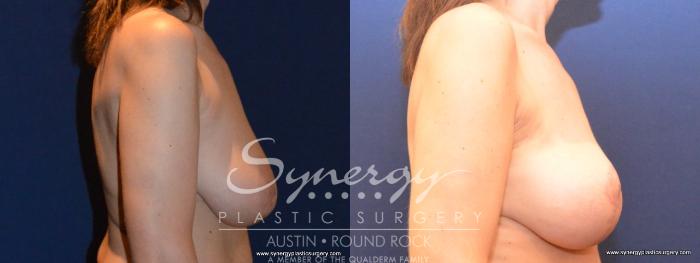 Before & After Breast Lift (Mastopexy) Case 407 View #3 View in Austin, TX