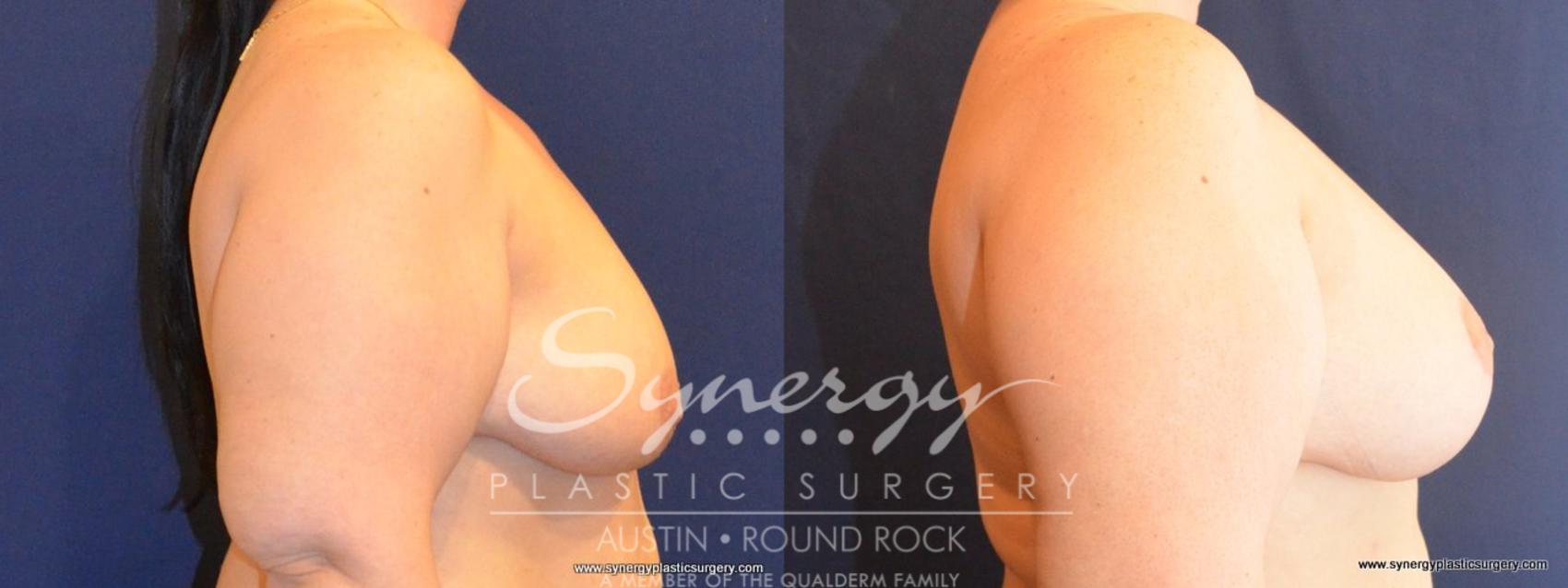 Before & After Breast Lift (Mastopexy) Case 412 View #2 View in Round Rock, TX