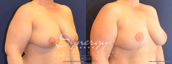 Before & After Breast Lift (Mastopexy) Case 412 View #3 View in Austin, TX