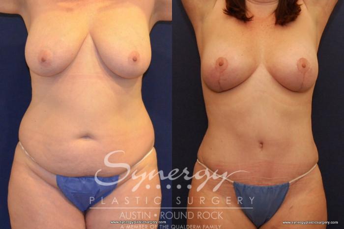 Before & After Breast Lift (Mastopexy) Case 434 View #2 View in Austin, TX