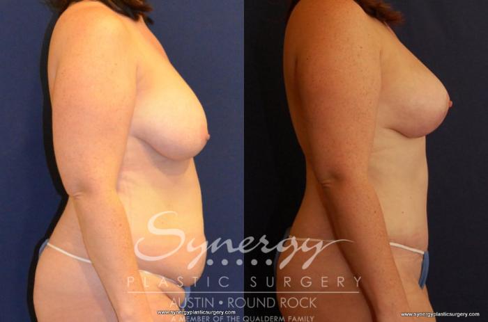 Before & After Breast Lift (Mastopexy) Case 434 View #3 View in Austin, TX