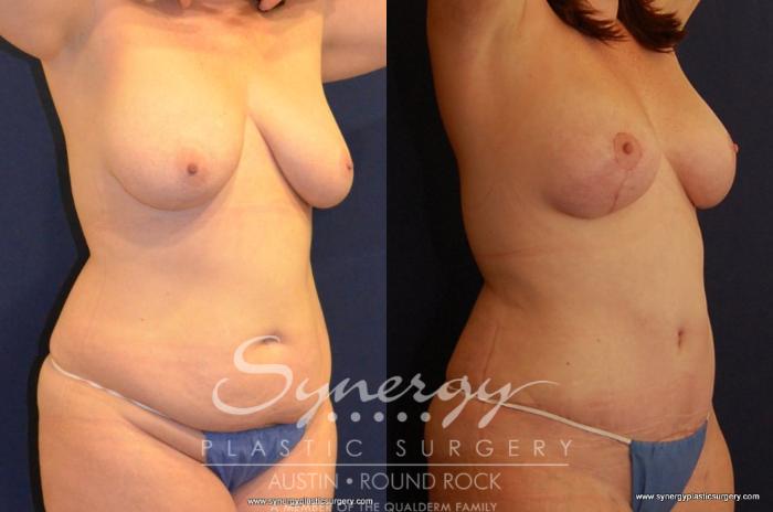Before & After Breast Lift (Mastopexy) Case 434 View #4 View in Austin, TX