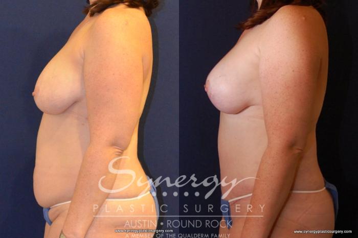 Before & After Breast Lift (Mastopexy) Case 434 View #5 View in Austin, TX