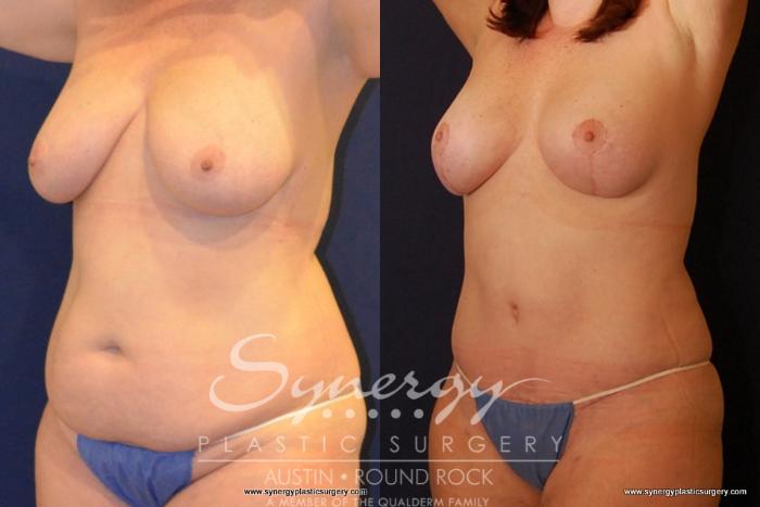 Before & After Breast Lift (Mastopexy) Case 434 View #6 View in Austin, TX