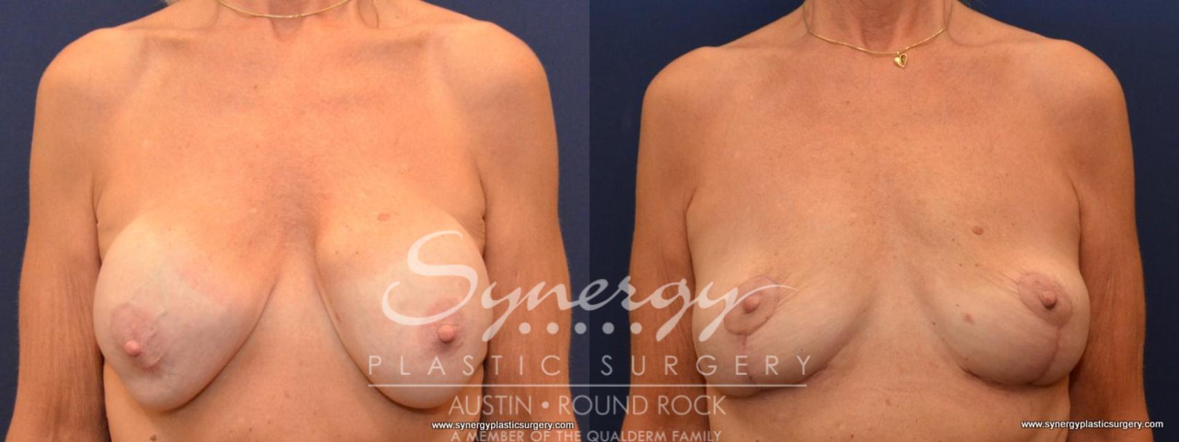 Before & After Breast Lift (Mastopexy) Case 438 View #1 View in Austin, TX