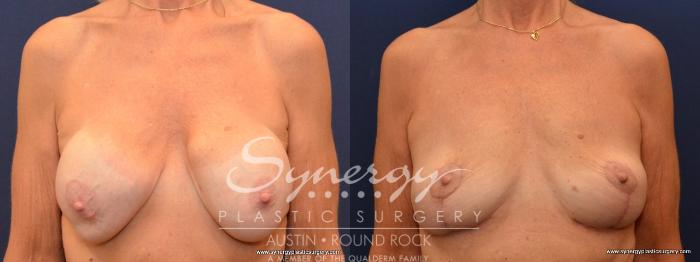 Before & After Breast Lift (Mastopexy) Case 438 View #1 View in Austin, TX