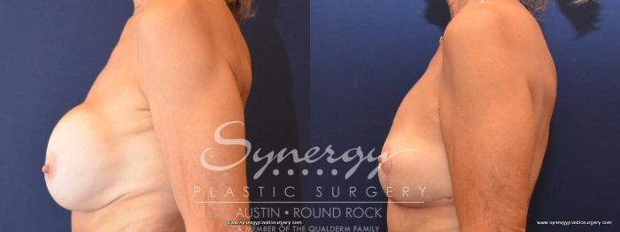 Before & After Breast Lift (Mastopexy) Case 438 View #2 View in Austin, TX