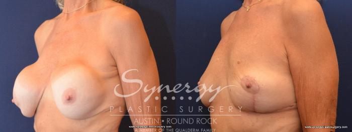 Before & After Breast Lift (Mastopexy) Case 438 View #3 View in Austin, TX
