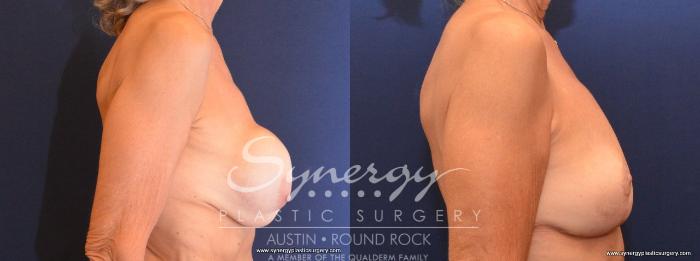 Before & After Breast Lift (Mastopexy) Case 438 View #4 View in Austin, TX