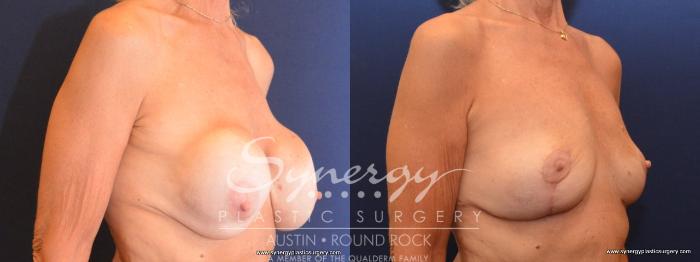 Before & After Breast Lift (Mastopexy) Case 438 View #5 View in Austin, TX