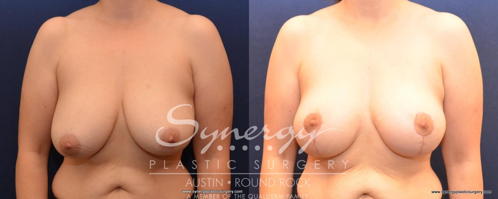 Before & After Breast Lift (Mastopexy) Case 489 View #1 View in Austin, TX