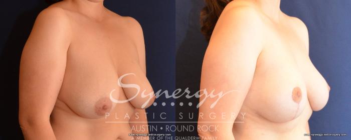 Before & After Breast Lift (Mastopexy) Case 489 View #2 View in Austin, TX