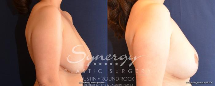 Before & After Breast Lift (Mastopexy) Case 489 View #3 View in Austin, TX
