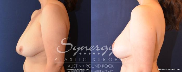Before & After Breast Lift (Mastopexy) Case 489 View #5 View in Austin, TX