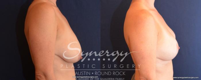 Before & After Breast Lift (Mastopexy) Case 507 View #2 View in Austin, TX