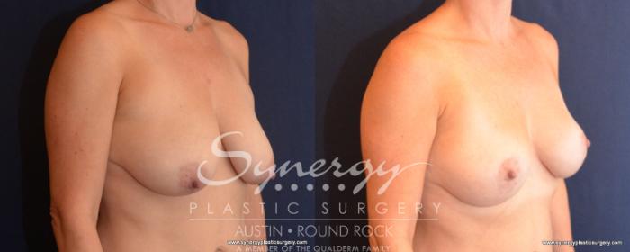 Before & After Breast Lift (Mastopexy) Case 507 View #3 View in Austin, TX