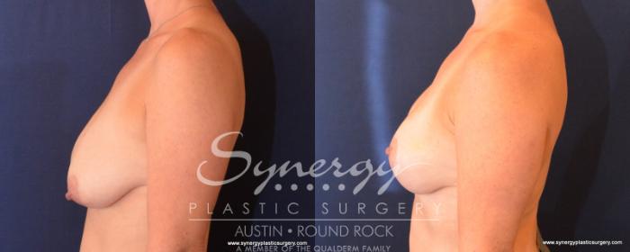 Before & After Breast Lift (Mastopexy) Case 507 View #4 View in Austin, TX