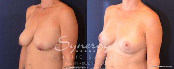 Before & After Breast Lift (Mastopexy) Case 507 View #5 View in Austin, TX