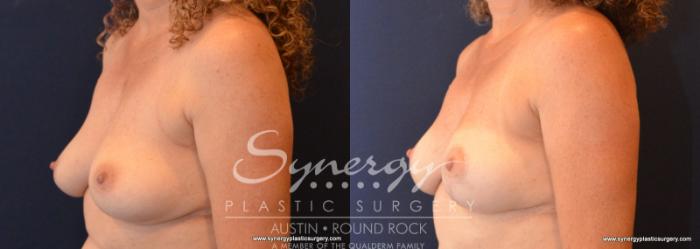 Before & After Breast Lift (Mastopexy) Case 596 View #2 View in Austin, TX