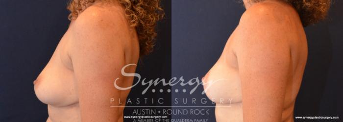 Before & After Breast Lift (Mastopexy) Case 596 View #3 View in Austin, TX