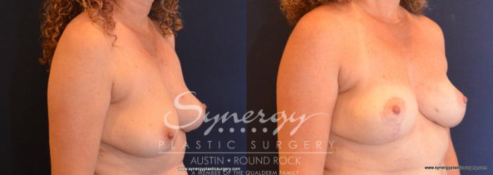 Before & After Breast Lift (Mastopexy) Case 596 View #4 View in Austin, TX
