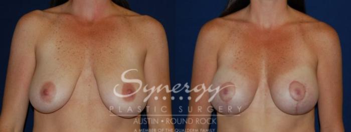 Before & After Breast Lift (Mastopexy) Case 64 View #2 View in Austin, TX