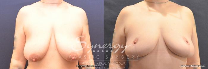 Before & After Breast Lift (Mastopexy) Case 787 View #1 View in Austin, TX