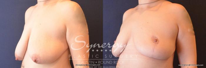 Before & After Breast Lift (Mastopexy) Case 787 View #2 View in Austin, TX