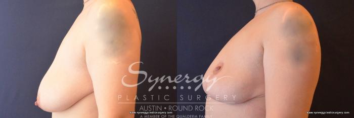 Before & After Breast Lift (Mastopexy) Case 787 View #3 View in Austin, TX