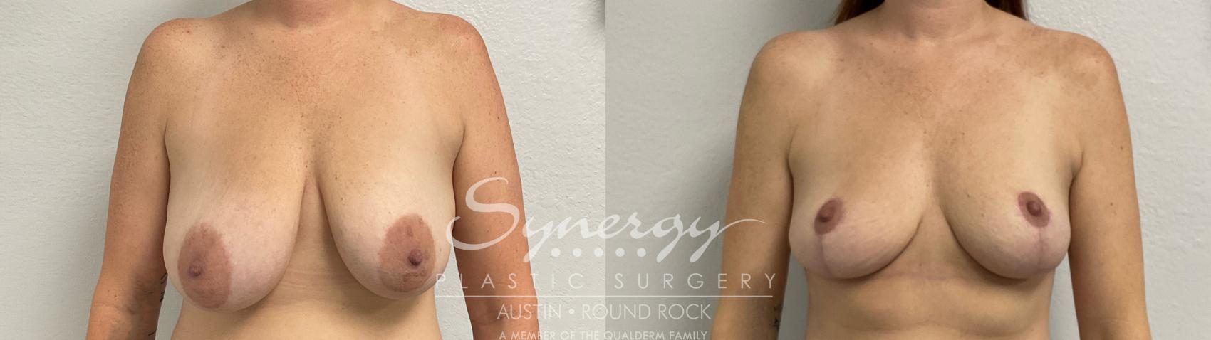 Before & After Breast Reduction Case 899 Front View in Austin, TX