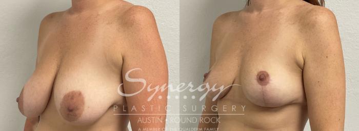 Before & After Breast Lift (Mastopexy) Case 899 Left Oblique View in Austin, TX