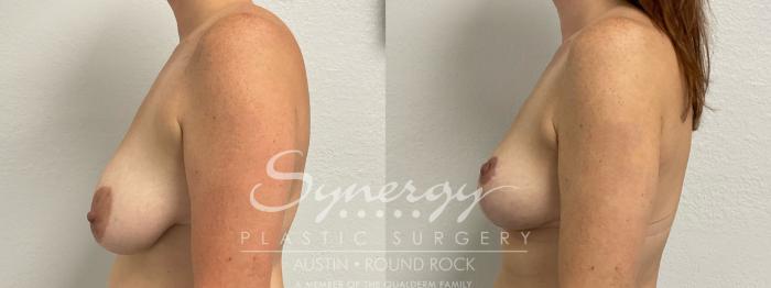 Before & After Breast Lift (Mastopexy) Case 899 Left Side View in Austin, TX