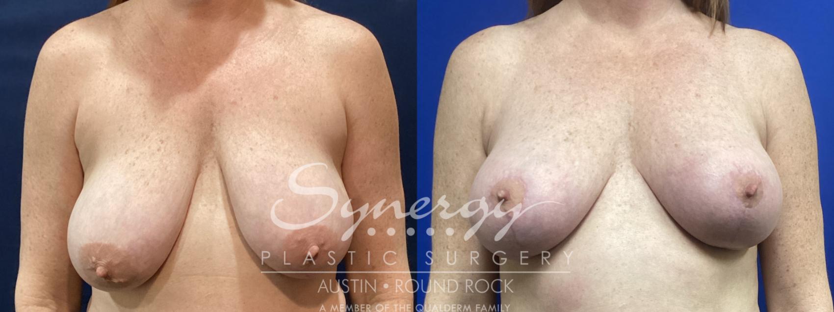 Before & After Breast Lift (Mastopexy) Case 903 Front View in Austin, TX