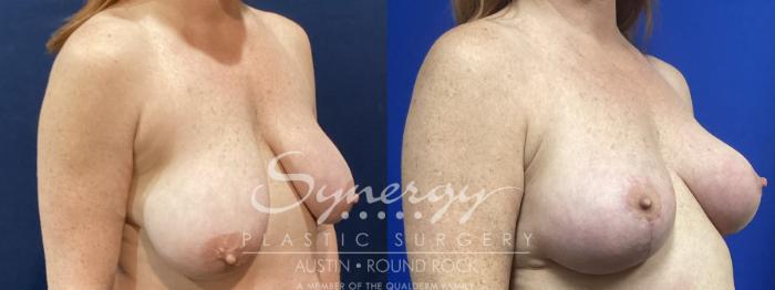 Before & After Breast Lift (Mastopexy) Case 903 Right Oblique View in Austin, TX