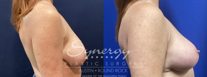 Before & After Breast Lift (Mastopexy) Case 903 Right Side View in Austin, TX