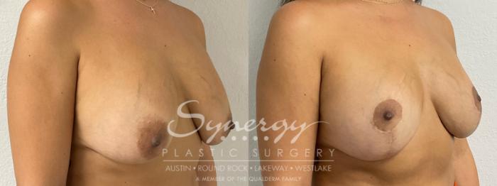 Breast Lift Implant Exchange Before & After Photos | 42-Year-Old Patient | Synergy Plastic Surgery Austin
