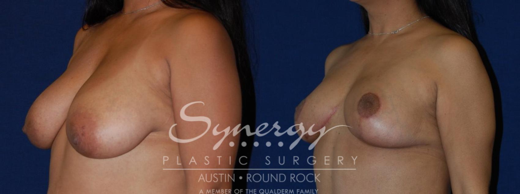 Before & After Breast Reduction Case 111 View #1 View in Austin, TX