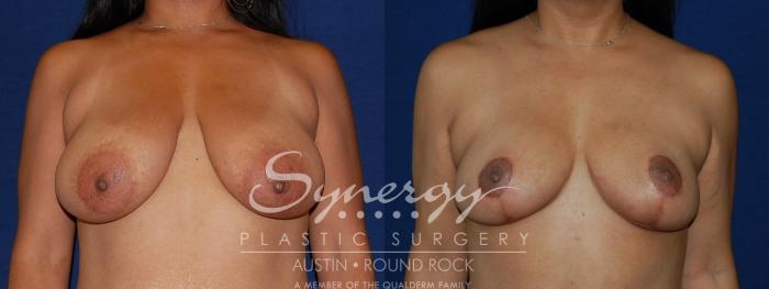 Before & After Breast Reduction Case 111 View #2 View in Austin, TX