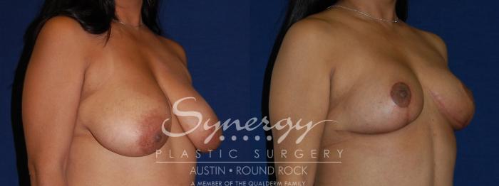 Before & After Breast Reduction Case 111 View #3 View in Austin, TX