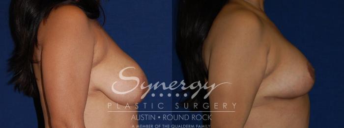Before & After Breast Reduction Case 111 View #4 View in Austin, TX