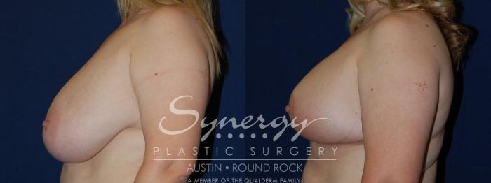 Before & After Breast Reduction Case 114 View #1 View in Austin, TX