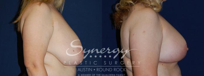 Before & After Breast Reduction Case 114 View #3 View in Austin, TX