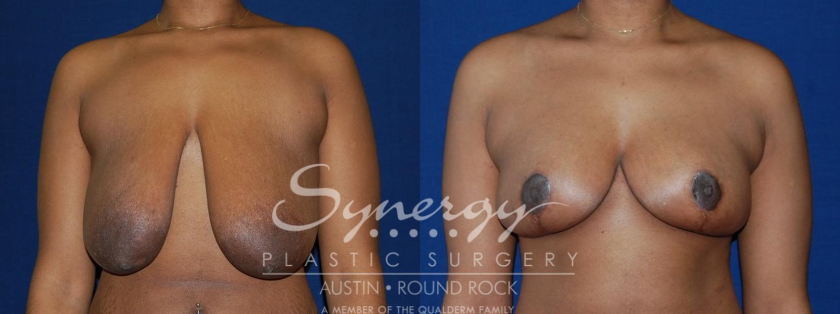 Before & After Breast Reduction Case 131 View #1 View in Austin, TX